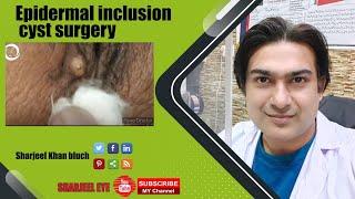 Epidermal inclusion cyst surgery