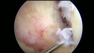 Anterior Cruciate Reconstruction with Medial Meniscus Root Repair