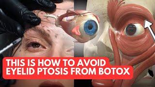 Avoid Eyelid Ptosis From Botox Treatments with THIS Anatomy Knowledge