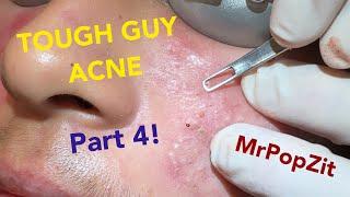 Tough Guy Acne part 4!Acne extractions.Make an appointment with me, details in description! Lets go!