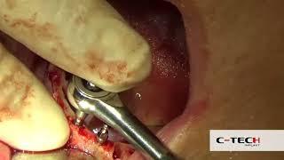 C-Tech Implant - Clinical Case with SD Small Diameter - Mini-Dental Implant