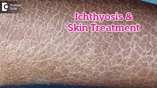 What is Ichthyosis? How to Treat my Skin?| Fish like scales On Skin-Dr.Rasya Dixit | Doctors' Circle