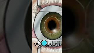 PreOp®  Clear Vision Ahead with LASIK Surgery! #preop #shorts #health 