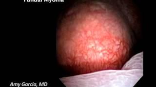 Diagnostic hysteroscopy with fundal myoma