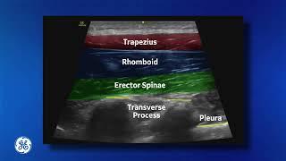 Venue Family | Erector Spinae Plane Block