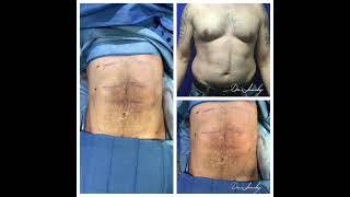 Before and after | Male breast Gynecomastia + Ab etching Before and after surgery |  Dr Jeneby