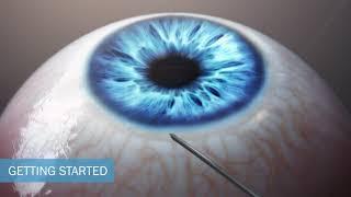 iTrack™, Canaloplasty for Glaucoma (Ab-Interno Surgical Technique)