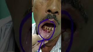 Cancer??#dentist #shorts By Dr.Jyoti Pandey…