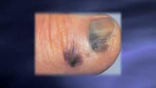 Skin Exams Catching Melanoma Earlier