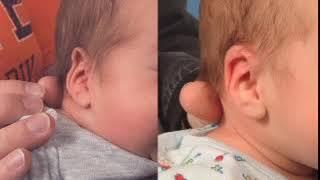 EarWell Ear Molding for Helical Rim Compression Infant Ear Deformity