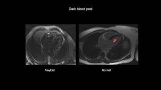 How to assess cardiac amyloidosis with CMR (cardiac magnetic resonance imaging)
