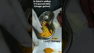 Leech therapy k baad kya karte hain? @vrayurved7490  #leechtherapy  #trending  #facebook  #ayurveda