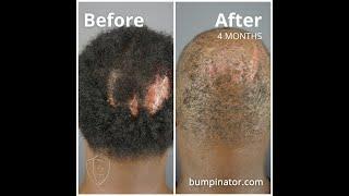 Dr. Bumpinator Terminates Folliculitis Decalvans with Athena Sutures!