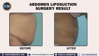 Liposuction Surgery  Procedure and its Results I Before-After Results of Abdominal Liposuction