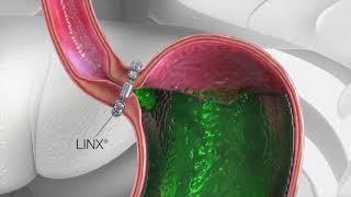 LINX Reflux Surgery Animation