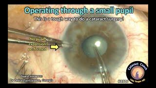 CataractCoach 1326: operating through a small pupil