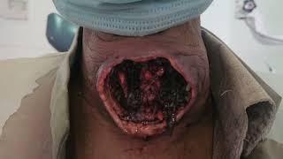 Maggots infestation of neck wound.