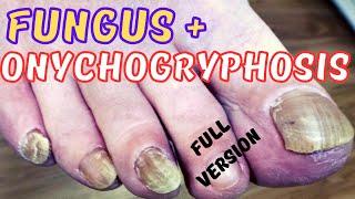 Thick fungal toenails treatment + rams horn (onychogryphosis)