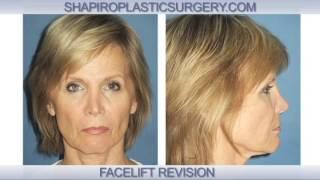 Facelift Revision Surgery