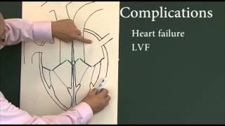 Heart disease 6, Complications of myocardial infarction