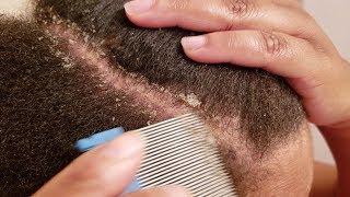 Removing Dandruff Flakes With Lice Comb