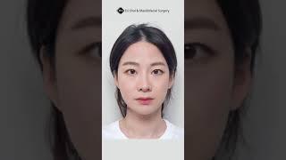 Korean Double Jaw + Vline + Cheekbone Reduction Surgery Results | (Before & After) #shorts