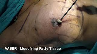 Huge glands removed in Gyno at Bliniq Cosmetic Surgery Centre I Dr Ashwani Kumar, Plastic Surgeon