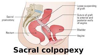 sacral colpopexy