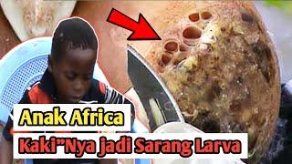 Fobia//Kaki Anak Africa JADI SARANG LaLat jigger #jigger #jiggers #jigger_digging