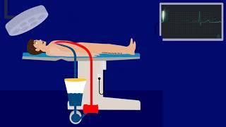 ECMO VS CPB