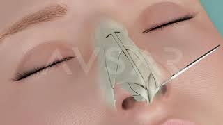 Video Endoscopic Micro Rhinoplasty Dr. Avşar in Istanbul Turkey