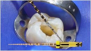 WaveOne Gold® Small Canals Technique with Dr. Willy Pertot | Dentsply Sirona