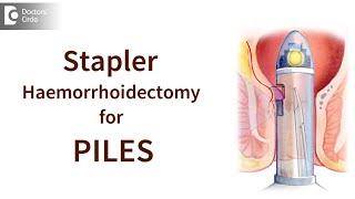 Minimally Invasive Procedure for Piles' (MIPS) or 'Stapler Haemorrhoidectomy - Dr.Nanda Rajneesh