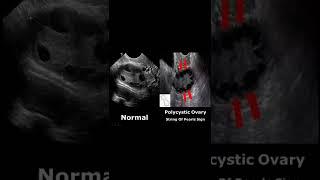 Polycystic Ovaries (PCOS) Ultrasound Image Appearances | Normal Vs Abnormal USG #shorts