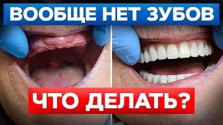 Что делать, если не осталось ни одного зуба во рту? / Импланты на все зубы