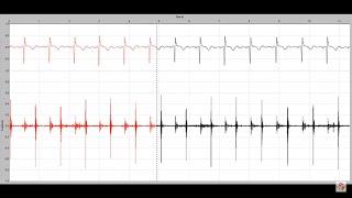 Systolic murmur in mitral regurgitation