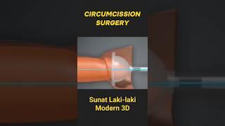 Sunat laser Modern 3D Untuk Laki-laki