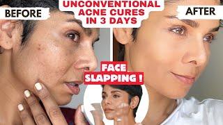 Face Yoga for ACNE and PIMPLE FREE Skin/ Get Clear Skin in 3 Days