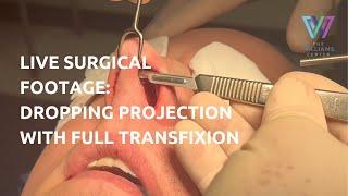 Live Rhinoplasty Surgical Footage: Reducing Projection in a Large Nose with Full Transfixion