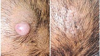 Cyst on scalp