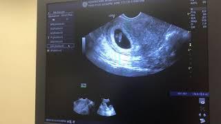 7 Week Ultrasound