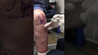 Anterior Knee Injection - Elite Sports Medicine - Lethbridge