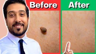 How to Remove Skin Tags Yourself AT HOME | Get Rid of Skin Tags NOW