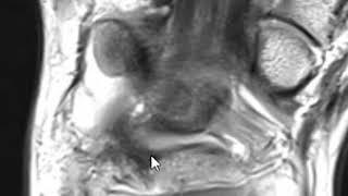 Ulnar abutment syndrome (i.e. ulnar impaction syndrome) with TFCC tear