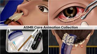 ASMR 가장 만족스러운 케어 애니메이션 모음ㅣ눈기름샘, 마이봄샘, 다래끼, 지루성 두피염, 코딱지 제거