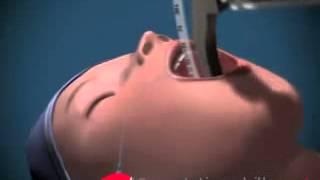 Endotracheal Intubation   Animated