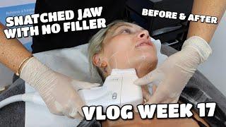 VLOG | CONTOURING MY JAW - NO FILLER OR NEEDLES (ULTRAcel Q+)