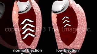 Heart Attack and Stroke - Animation and Narration by Cal Shipley, M.D.