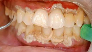 Dental Scaling of Tartar Affecting Gums Badly.  Amazing Results after Plaque Removal. Dr Ram MDS