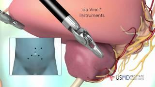 Catheter-less Robotic Prostatectomy at USMD PCC